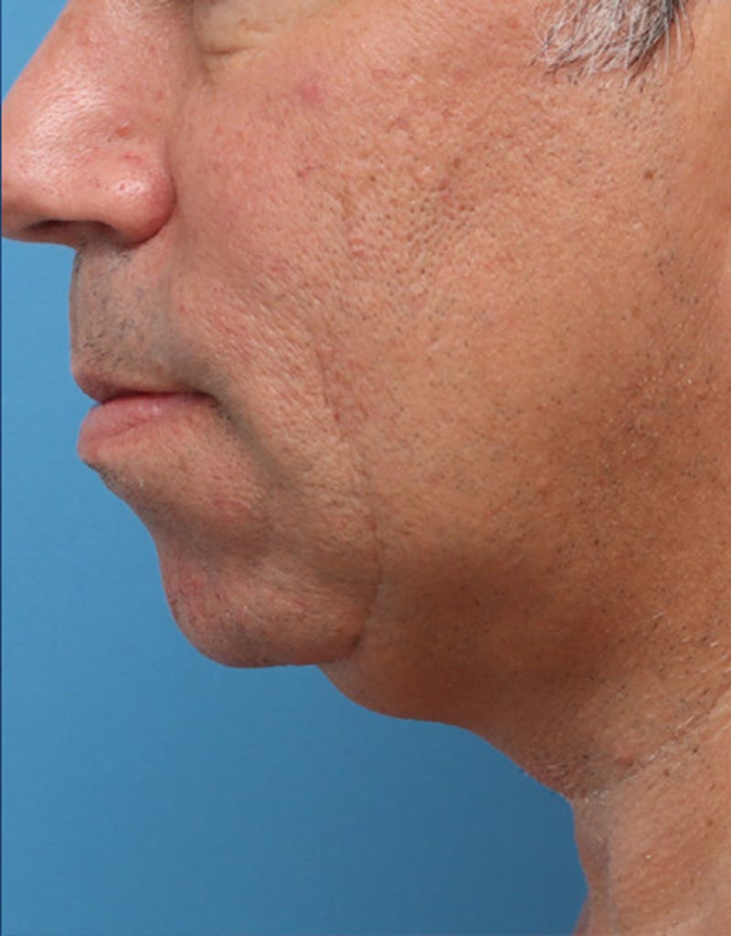 Other Nonsurgical Before & After Gallery - Patient 414834 - Image 8