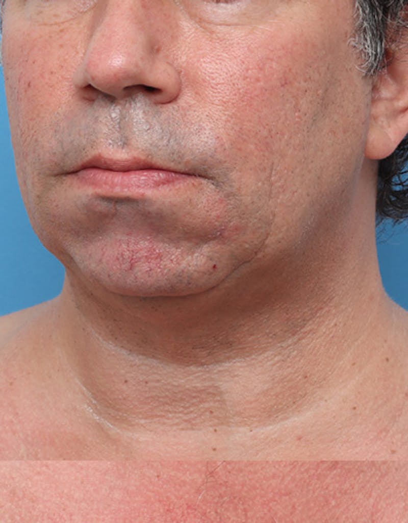Patient TPkk2EqwSi-R1GSOlx8NWQ - Evoke Before & After Photos