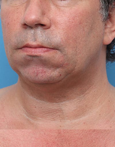 Other Nonsurgical Before & After Gallery - Patient 414834 - Image 1