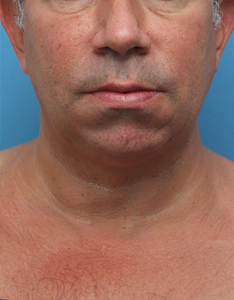 Other Nonsurgical Before & After Gallery - Patient 414834 - Image 4
