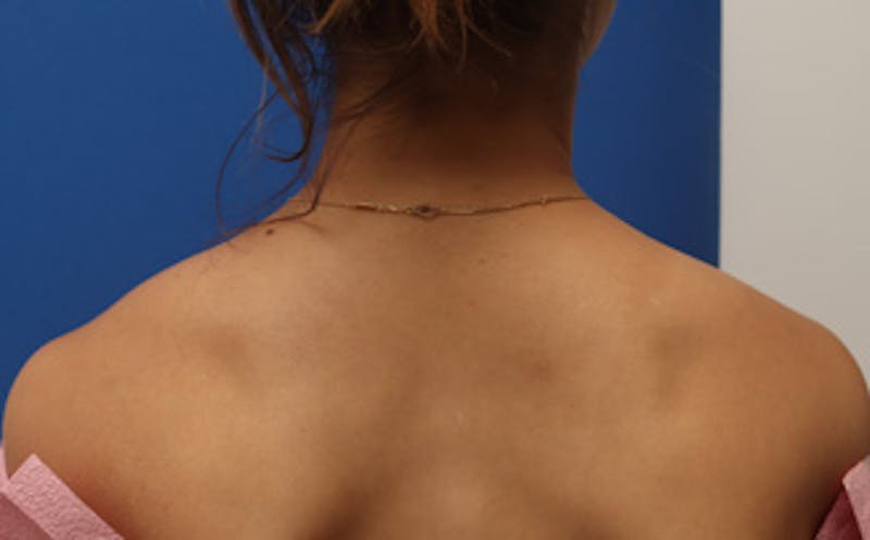 BOTOX Before & After Gallery - Patient 361828 - Image 1