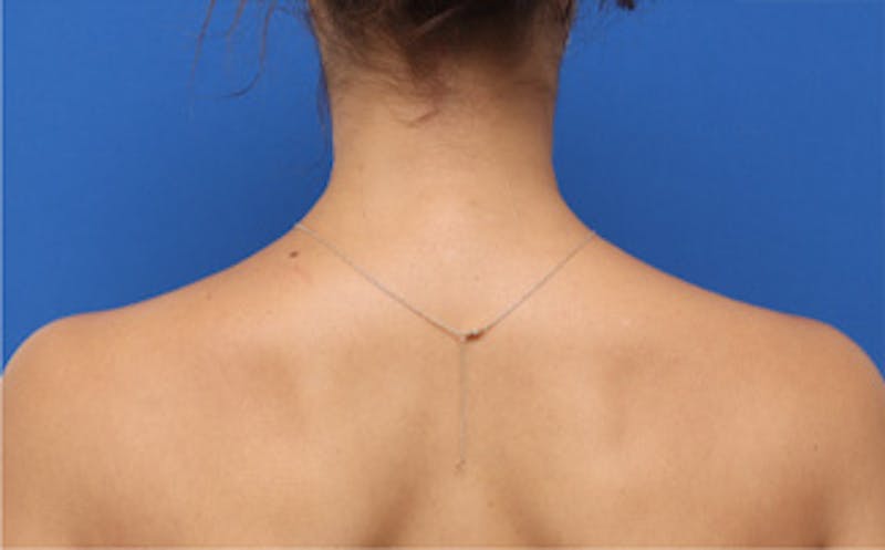 BOTOX Before & After Gallery - Patient 361828 - Image 2
