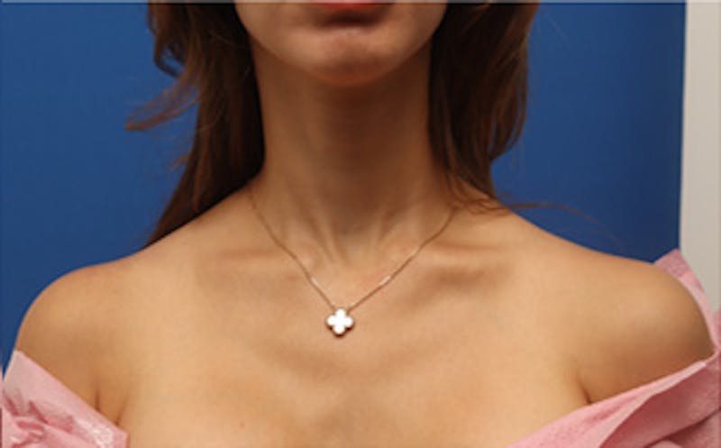 BOTOX Before & After Gallery - Patient 361828 - Image 3
