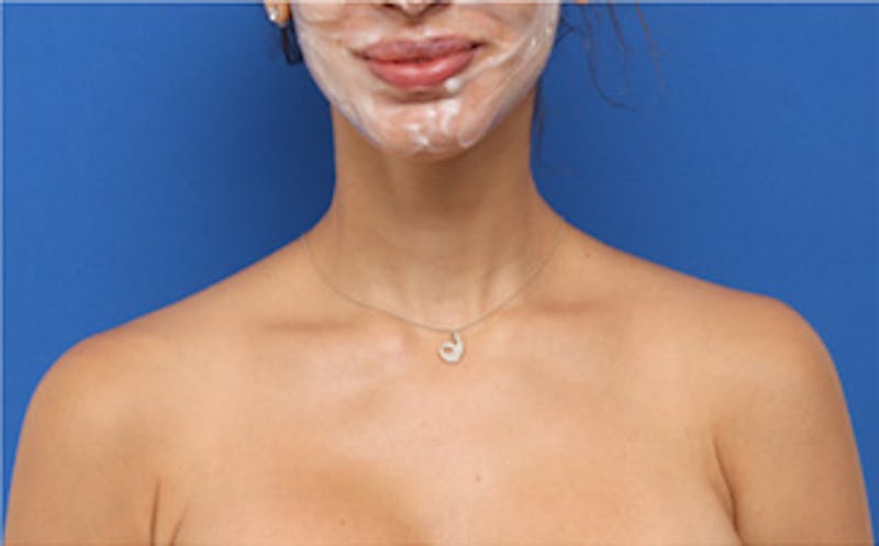BOTOX Before & After Gallery - Patient 361828 - Image 4