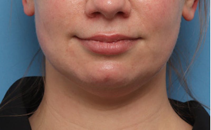 BOTOX Before & After Gallery - Patient 910614 - Image 1