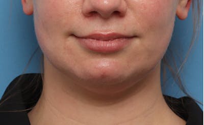 BOTOX Before & After Gallery - Patient 910614 - Image 1
