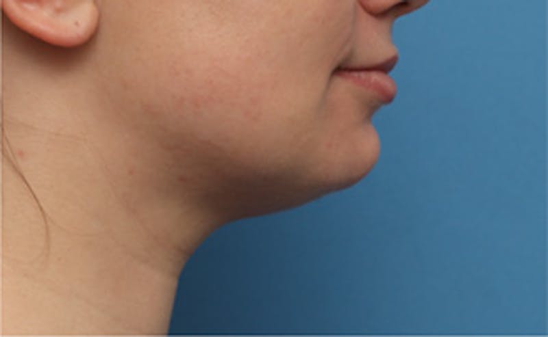BOTOX Before & After Gallery - Patient 910614 - Image 4
