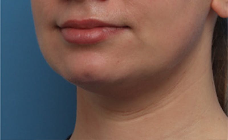 BOTOX Before & After Gallery - Patient 910614 - Image 8