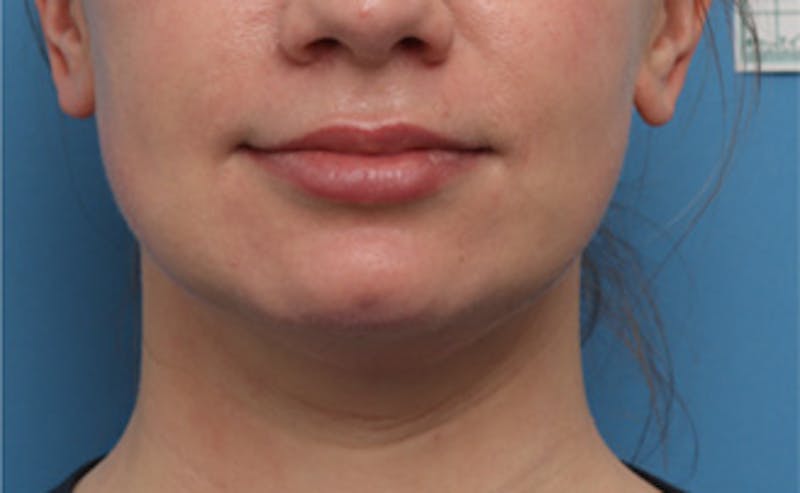 BOTOX Before & After Gallery - Patient 910614 - Image 2