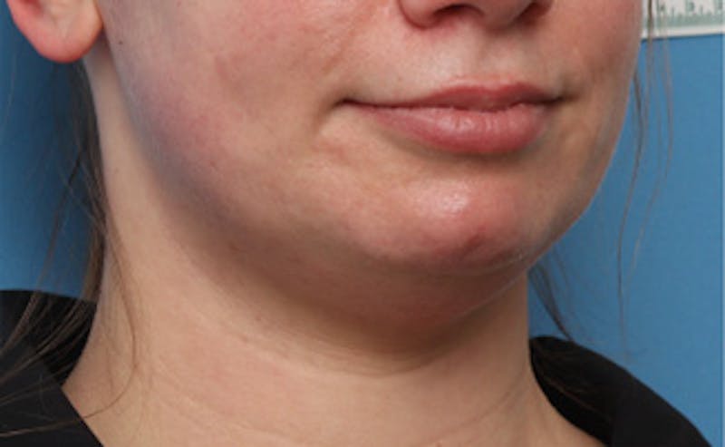 BOTOX Before & After Gallery - Patient 910614 - Image 5