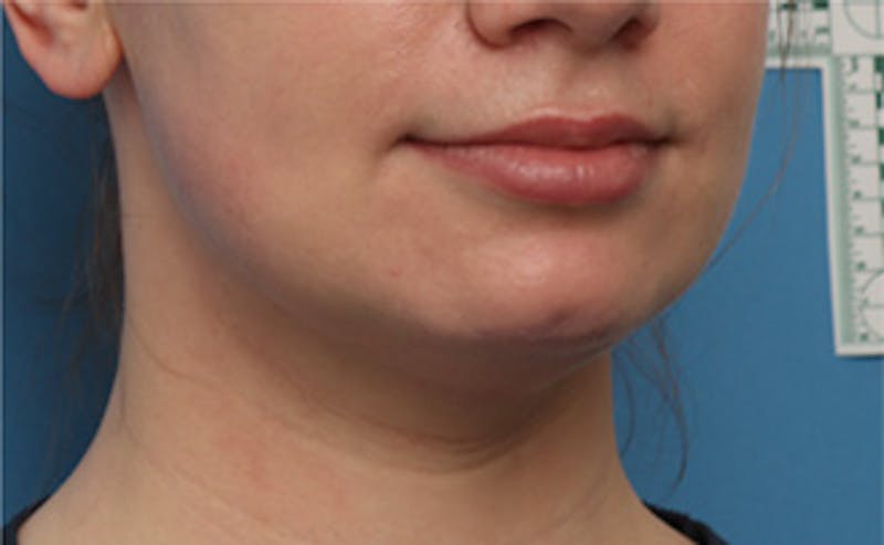 BOTOX Before & After Gallery - Patient 910614 - Image 6
