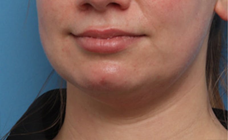 BOTOX Before & After Gallery - Patient 910614 - Image 7