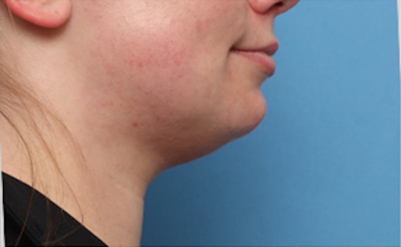 BOTOX Before & After Gallery - Patient 910614 - Image 3