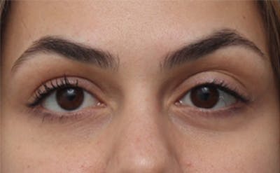 EZ Gel PRF Before & After Gallery - Patient 252550 - Image 1