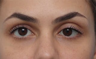 EZ Gel PRF Before & After Gallery - Patient 252550 - Image 2