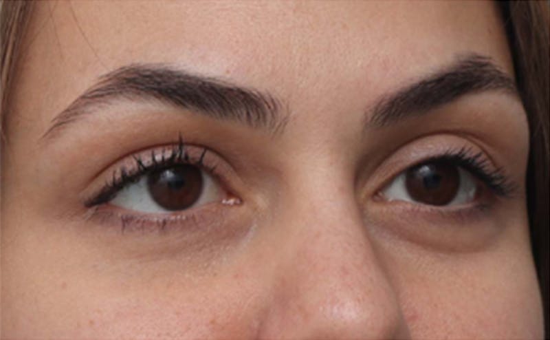 EZ Gel PRF Before & After Gallery - Patient 252550 - Image 3