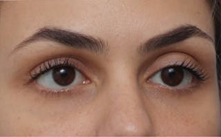 EZ Gel PRF Before & After Gallery - Patient 252550 - Image 4