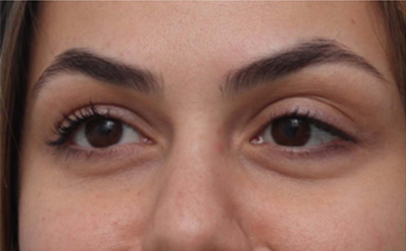 EZ Gel PRF Before & After Gallery - Patient 252550 - Image 5
