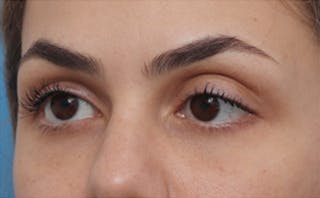 EZ Gel PRF Before & After Gallery - Patient 252550 - Image 6