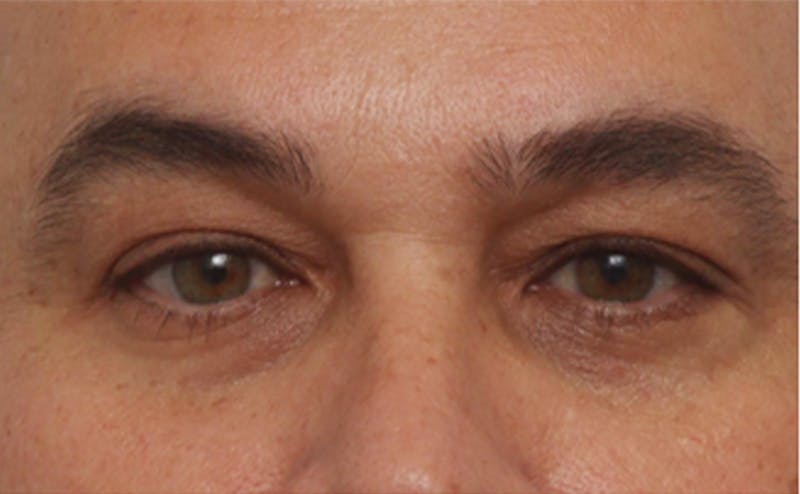 Patient MSqvTsXrS-mn-mZq66_I3g - EZ Gel PRF Before & After Photos