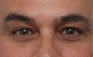 EZ Gel PRF Before & After Gallery - Patient 334649 - Image 2