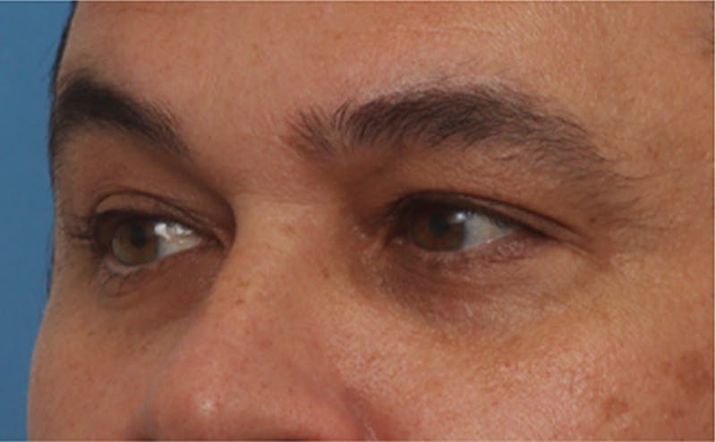 EZ Gel PRF Before & After Gallery - Patient 334649 - Image 3