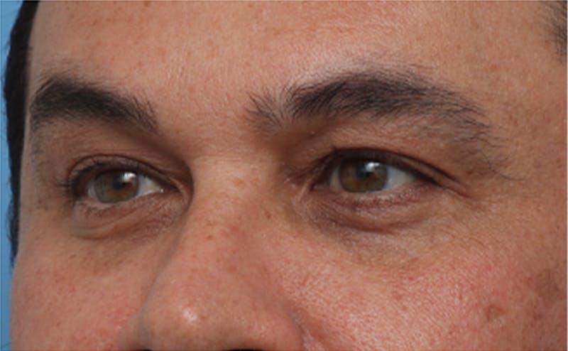 EZ Gel PRF Before & After Gallery - Patient 334649 - Image 4