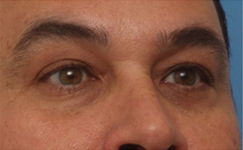 EZ Gel PRF Before & After Gallery - Patient 334649 - Image 5