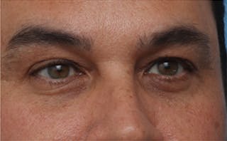 EZ Gel PRF Before & After Gallery - Patient 334649 - Image 6