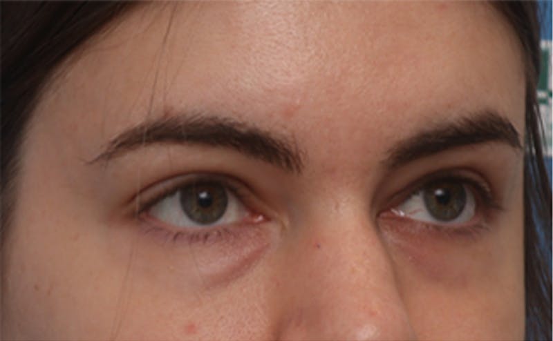 EZ Gel PRF Before & After Gallery - Patient 217150 - Image 5