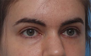 EZ Gel PRF Before & After Gallery - Patient 217150 - Image 6