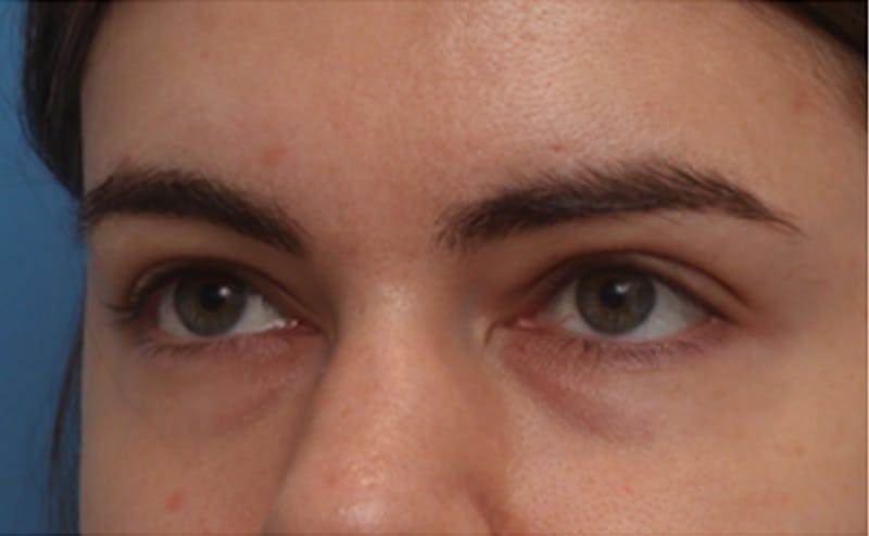 EZ Gel PRF Before & After Gallery - Patient 217150 - Image 3