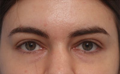 EZ Gel PRF Before & After Gallery - Patient 217150 - Image 1