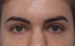 EZ Gel PRF Before & After Gallery - Patient 217150 - Image 2