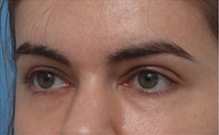 EZ Gel PRF Before & After Gallery - Patient 217150 - Image 4