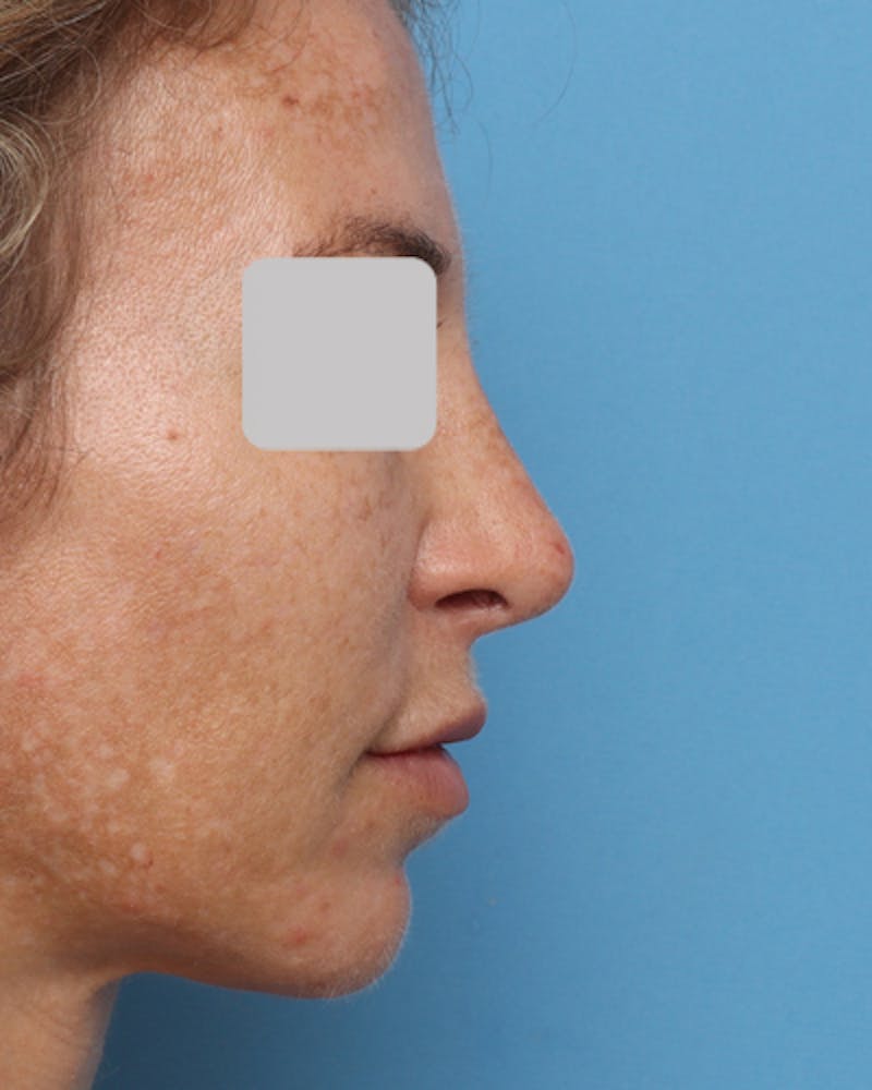 Lip Lift Before & After Gallery - Patient 167005 - Image 8