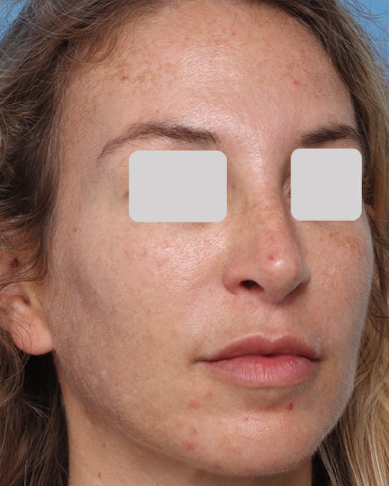 Lip Lift Before & After Gallery - Patient 167005 - Image 4