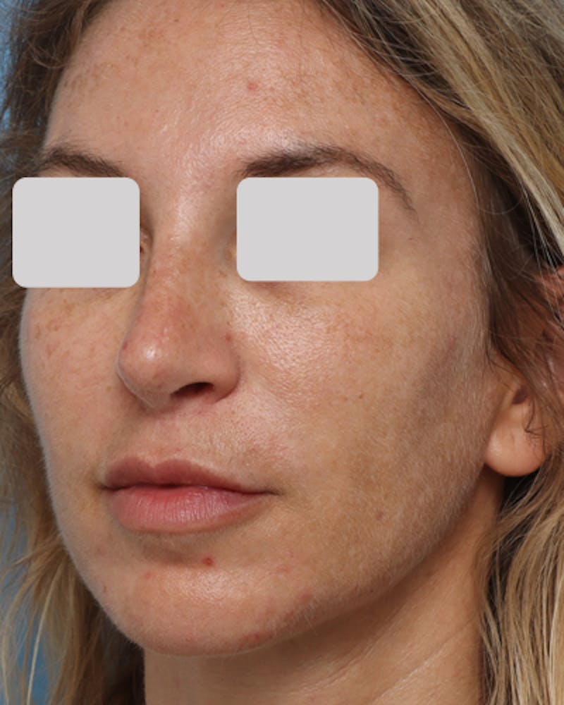 Lip Lift Before & After Gallery - Patient 167005 - Image 6