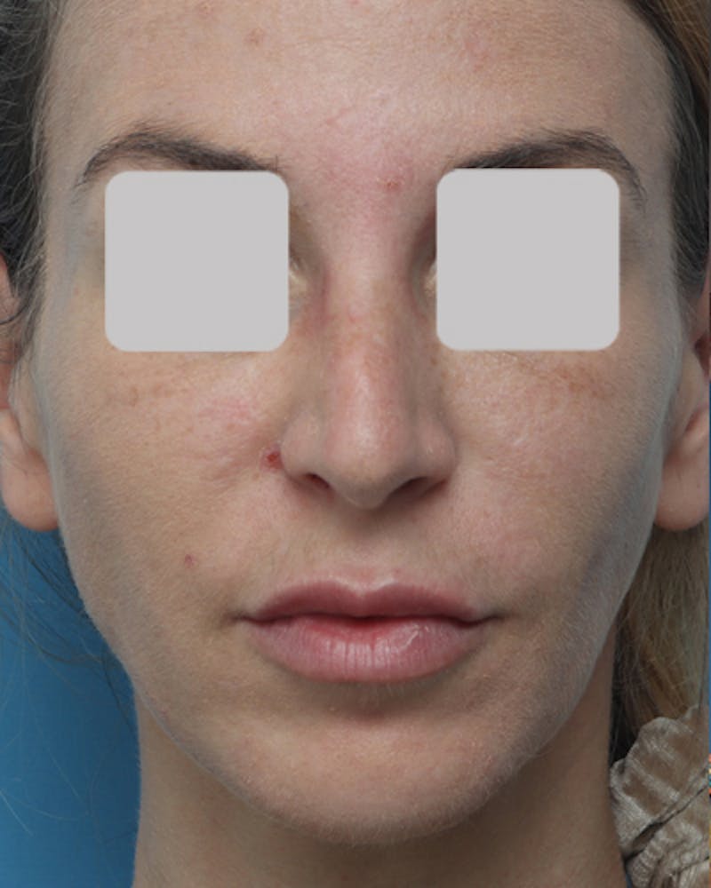 Patient L7PHnILJQl-MUhIh1Am1oA - Lip Lift Before & After Photos