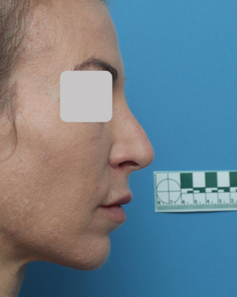 Lip Lift Before & After Gallery - Patient 167005 - Image 7