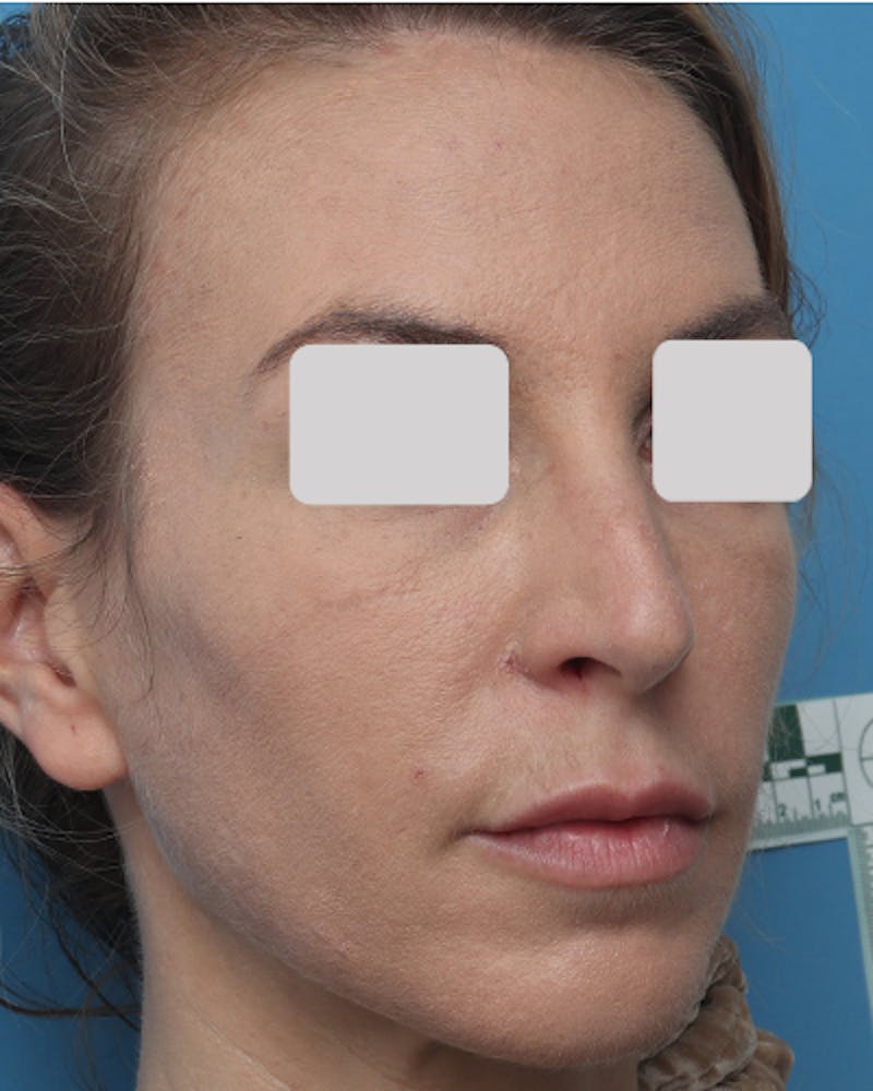 Lip Lift Before & After Gallery - Patient 167005 - Image 3