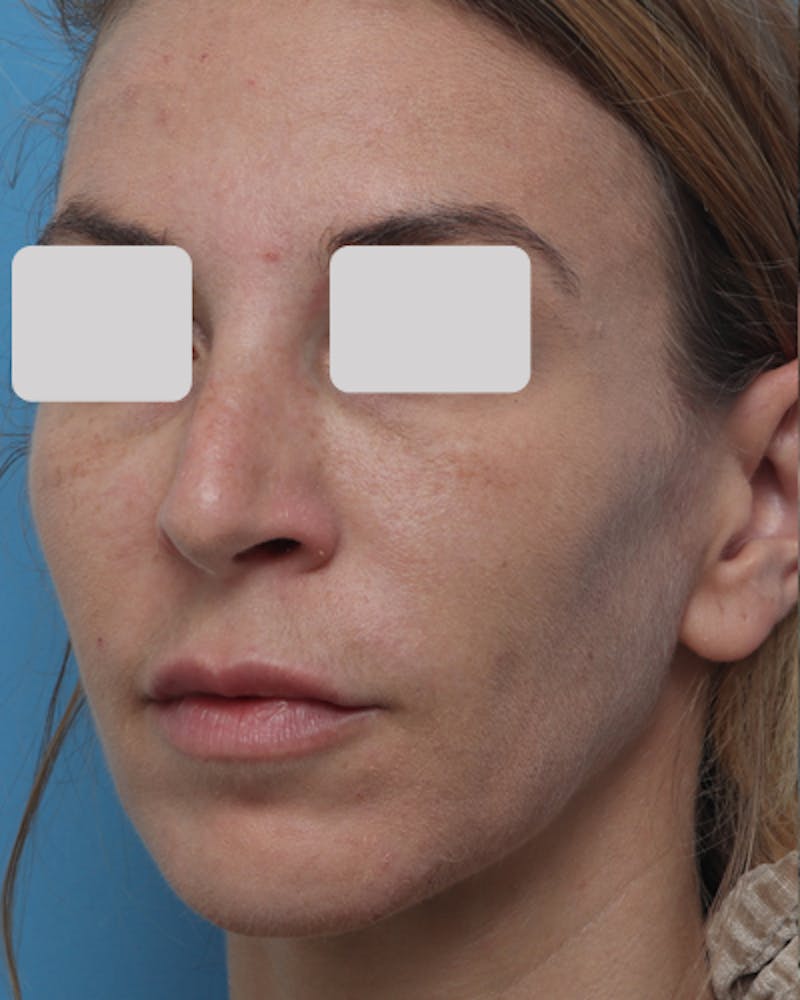 Lip Lift Before & After Gallery - Patient 167005 - Image 5