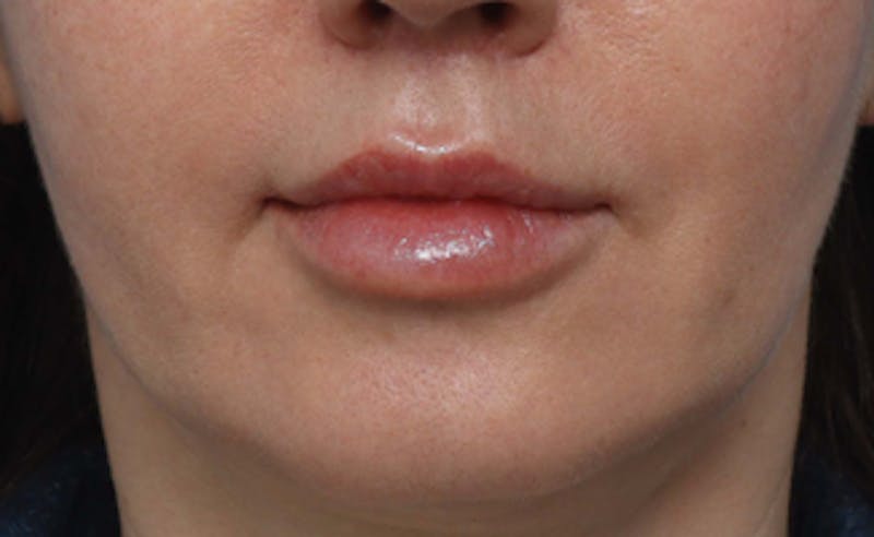 Lip Lift Before & After Gallery - Patient 200488 - Image 2