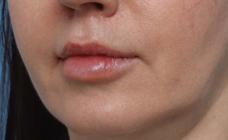 Lip Lift Before & After Gallery - Patient 200488 - Image 8
