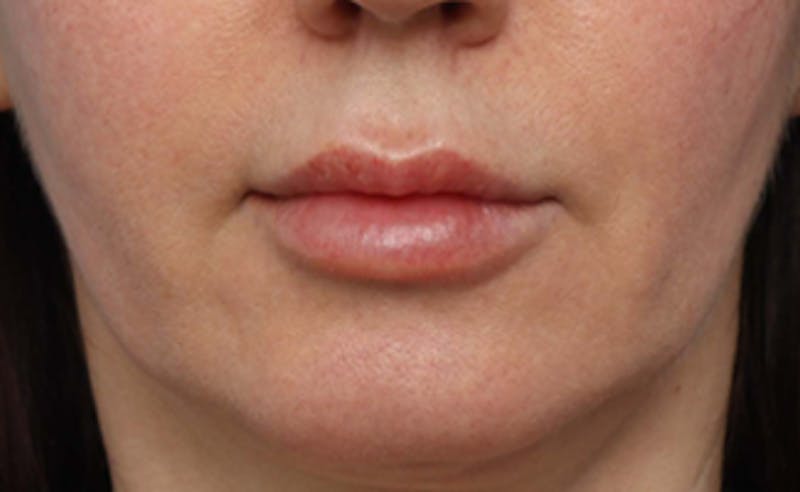 Lip Lift Before & After Gallery - Patient 200488 - Image 1