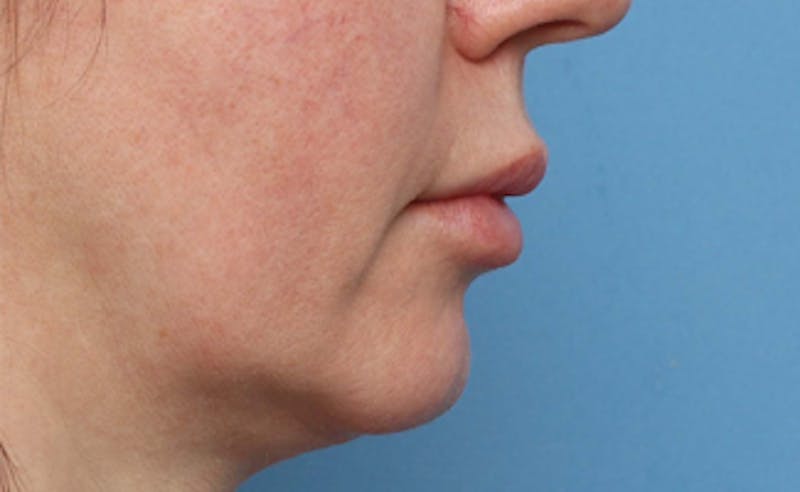 Lip Lift Before & After Gallery - Patient 200488 - Image 5