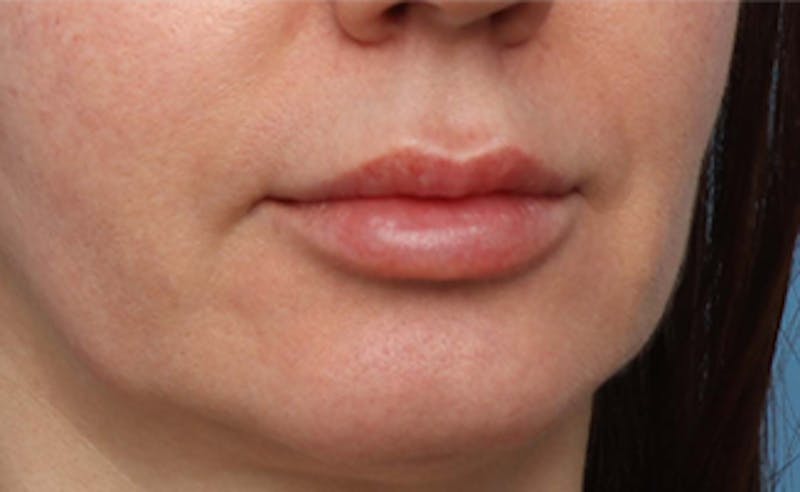 Lip Lift Before & After Gallery - Patient 200488 - Image 3