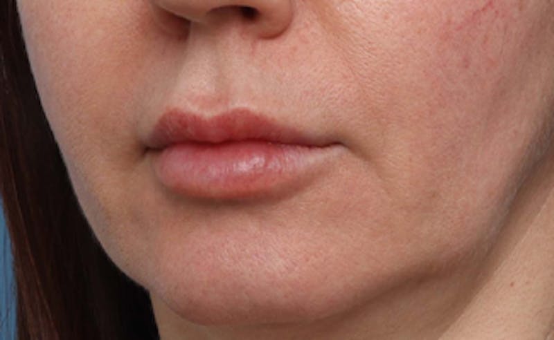 Lip Lift Before & After Gallery - Patient 200488 - Image 7