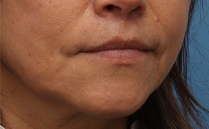 Lip Lift Before & After Gallery - Patient 163407 - Image 4