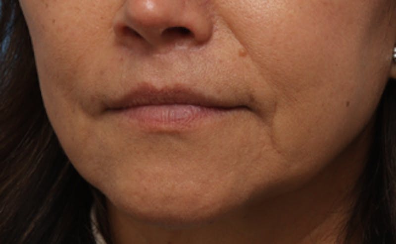 Lip Lift Before & After Gallery - Patient 163407 - Image 8
